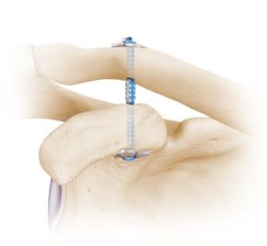 Acromioclavicular Joint Reconstruction Adelaide - Dr Chiewen liew